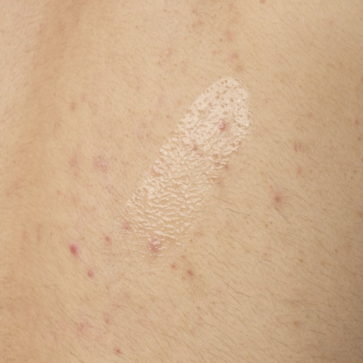 salicylic-acid-0-5-body-serum-h5 ORD-salicylic-acid-05-body-240ml-application.jpg