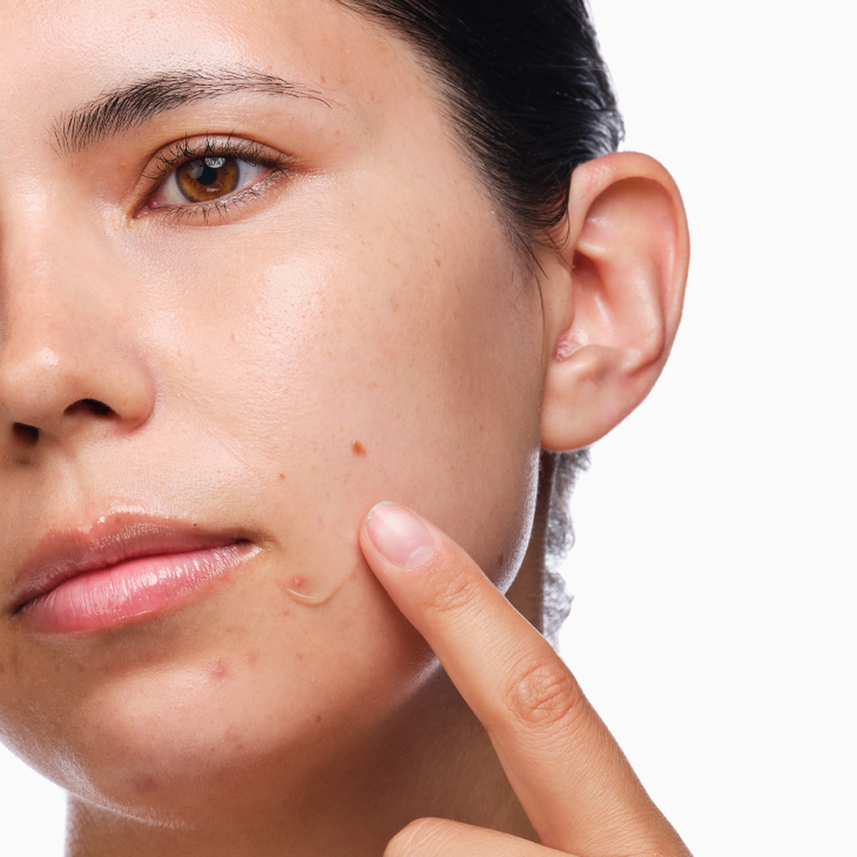 the-acne-set-w2 rdn-the-acne-set-application.png